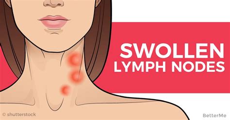 Recognize On Time Swollen Lymph Nodes In The Neck