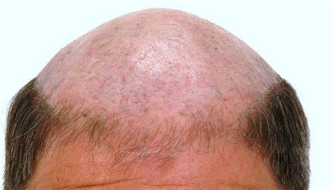Iron Deficiency Hair Loss - Causes, Symptoms, and How To Treat It
