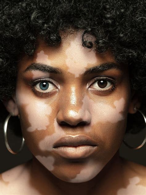 Studio Portrait Av Africanamerican Kvinna Med Vitiligo Skönhetskoncept