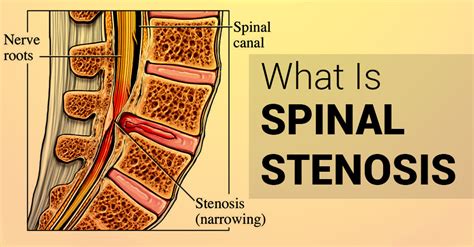 Spinal Stenosis Causes Symptoms And Treatment