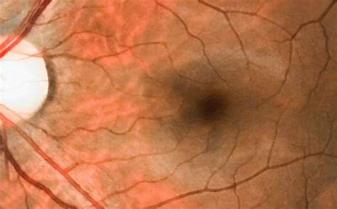 Study Explores Central Retinal Artery Occlusion Imaging Options