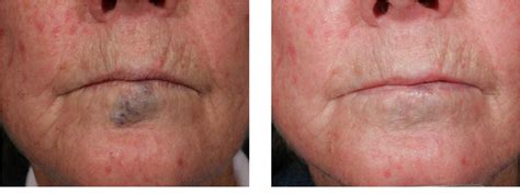 Laser For Facial Redness Before And After Cosmetic Surgery Tips