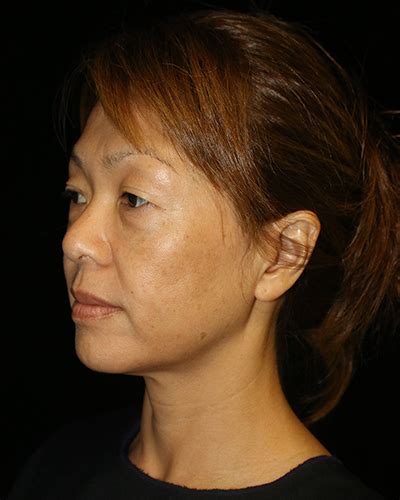 Patient 11603 Facial Fat Grafting Before And After Photos San Diego