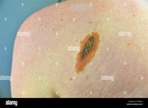 Macro Shot Of Benign Skin Lesion Proliferation Of Pigment Derma Cells