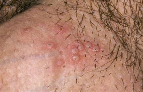 Razor burn, an uncomfortable skin irritation that can happen after you shave, may also cause small bumps and blisters. Ingrown Hair on Female Privy Area, Prevent, Treat & Home ...