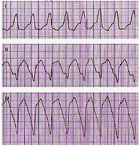 Ventricular Tachycardia Vt Download Scientific Diagram