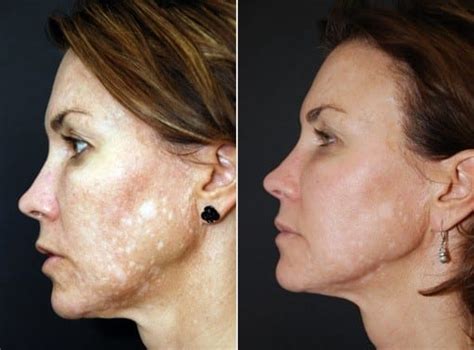 Vi Peels Before And After Photo Gallery Dr Dean Kane