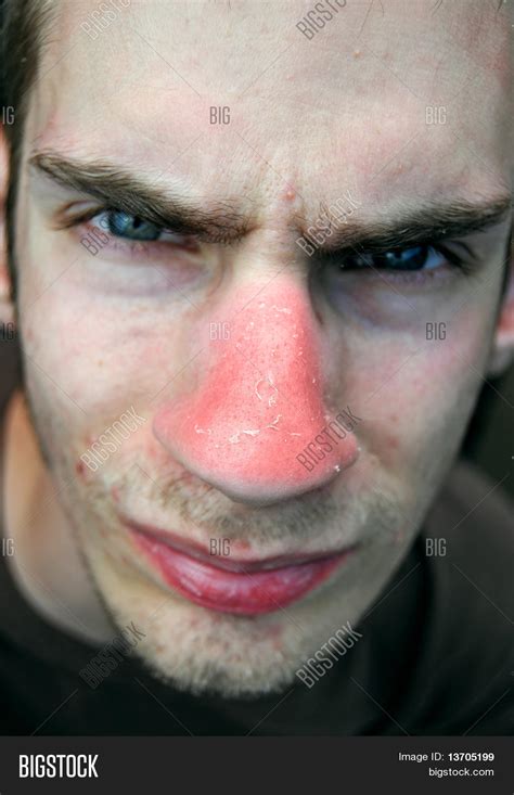 Nose Sunburn Image And Photo Free Trial Bigstock