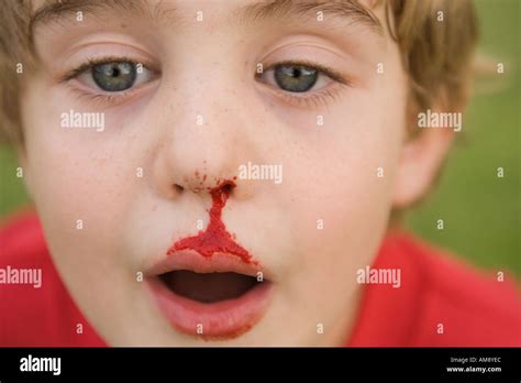 Boy With Bleeding Nose Stock Photo 4959211 Alamy
