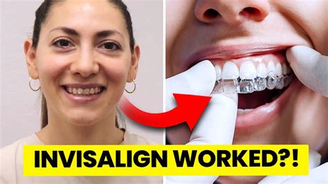 Does Invisalign Really Work Orthodontist Explains Youtube