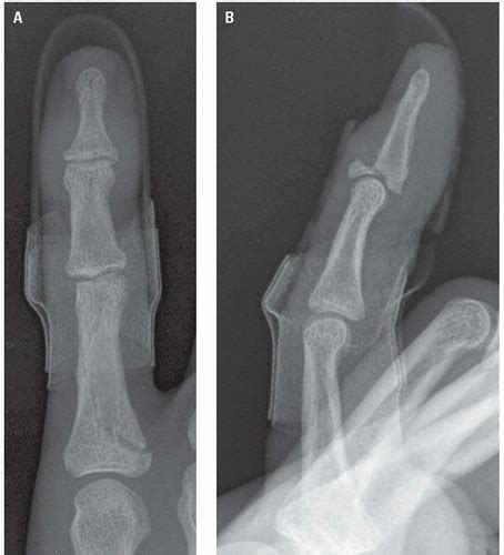 Hand | Radiology Key