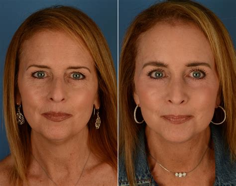 The UpLift™ Lower Face and Neck Lift Photos | Naples, FL | Patient 14192