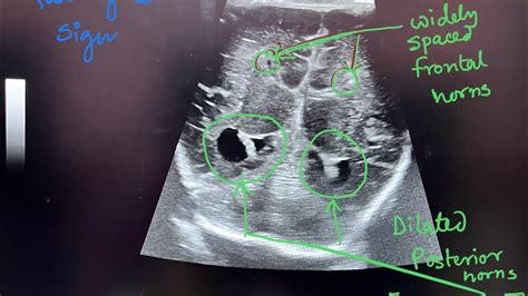 Corpus Callosum Agenesis Ultrasound Case 2 Youtube