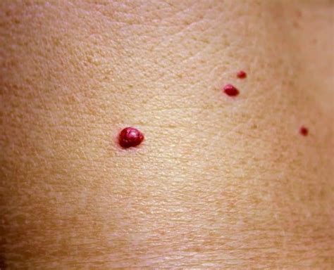 Cherry Angioma And Pcos Skin Spots Purple Spots On Skin Red Skin Spots