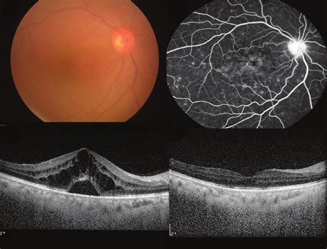 Fundus Photography Fluorescein Angiography And Optical Coherence