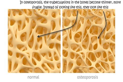 Osteoporosis Trabeculae Abingdon Chiropractic Clinic