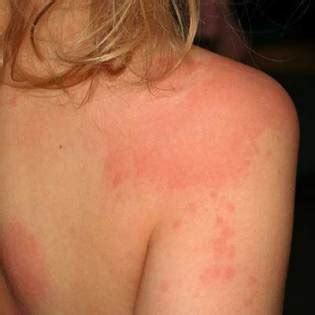 It can last for days to weeks depending few days: Allergic Reaction Images Of Hives - 10lilian