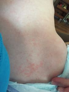 What causes a food allergy rash? Baby Food Allergy Rash Pictures - Food Ideas