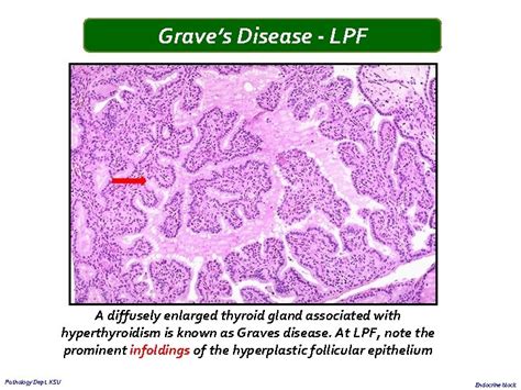 Graves Disease Histology Hashimoto Thyroiditis Pathology Student