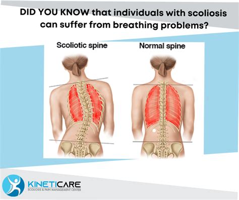 Breathing Problems Associated With Scoliosis Did You Know That Individuals With Scoliosis Can