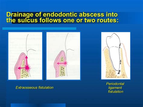 Periodontitis Associated With Endodontic Lesions