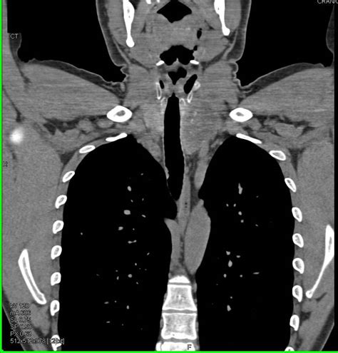 Substernal Thyroid Pushes On Airway Chest Case Studies Ctisus Ct