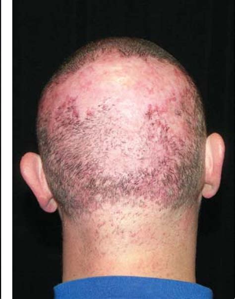 Pdf Folliculitis Decalvans Of The Scalp Response To Triple Therapy