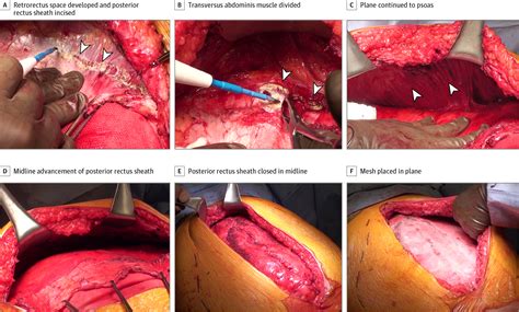 Incisional Hernia Surgery : laparoscopic ventral hernia 