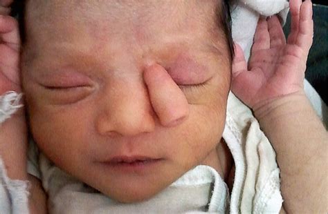 trunklike projection in 10 day old girl congenital defects jama pediatrics the jama network