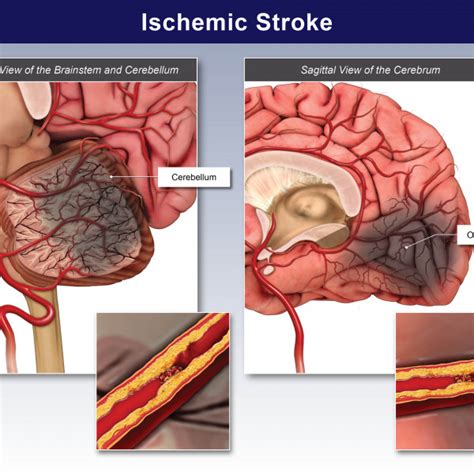 Ischemic Stroke Trialexhibits Inc