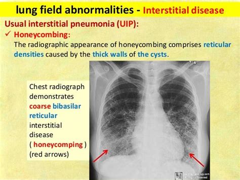Lung Field Abnormalities Interstitial Disease Usual Interstitial