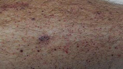 Petechiae Pinprick Red Dots On Skin Not Itchy Causes And Treatment Of