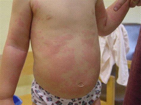 Urticaria Hives Children Nuhs