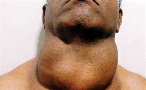 What Do You Mean By Goiter What Are The Causes Symptoms And Treatment