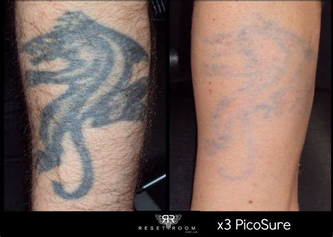 Laser Tattoo Removal Before And After Photos Best Tattoo Ideas