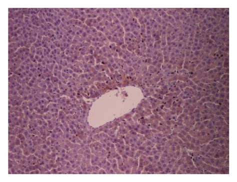A Hepatocellular Necrosis In Zone 3 Of The Hepatic Lobule And