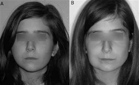 Case 2 A Frontal Pre Operative Picture Showing Severe Facial