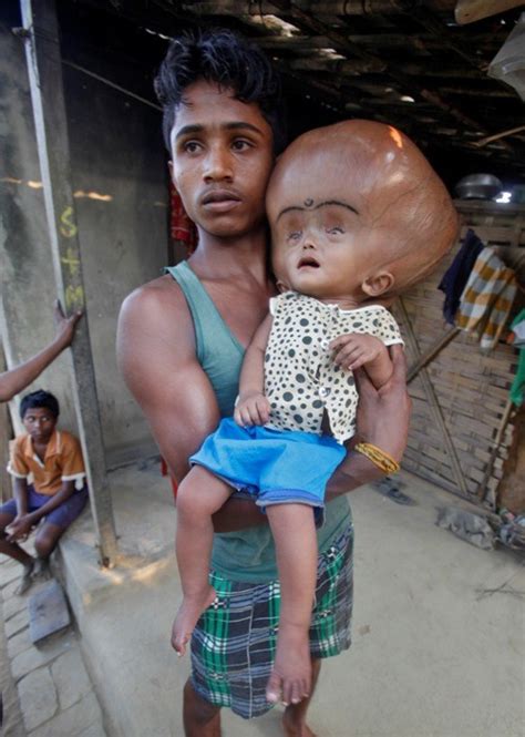 Roona Begum Giant Head Baby Set For Another Skull Reduction Surgery