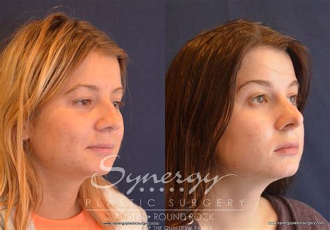 Rhinoplasty Before And After Pictures Case Austin TX Synergy Plastic Surgery