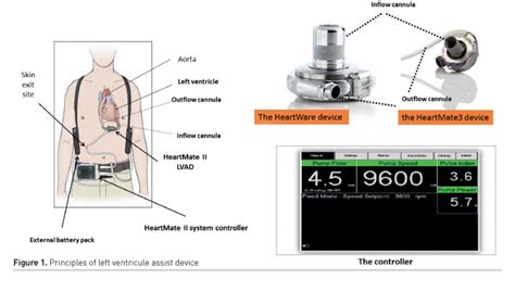 Understanding Lvad And Artificial Hearts
