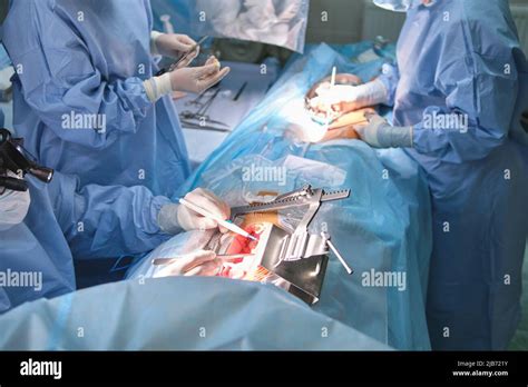 Team Of Professional Doctors Operating A Patient Conducting Open Heart