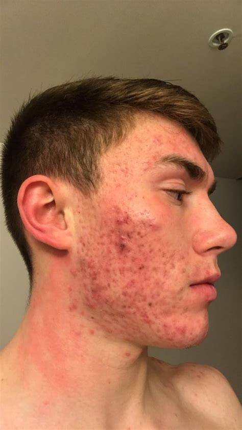 Severe Cystic Acne I Need Help Acne