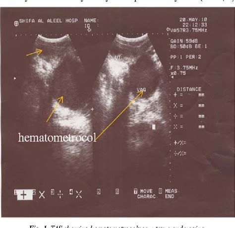 Figure From Case Report Diagnosing Of Imperforate Hymen By Ultrasound Semantic Scholar