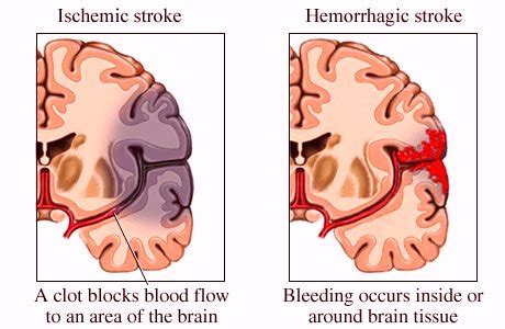 Hemorrhagic Stroke Treatment Symptoms Prognosis Recovery