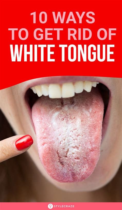 10 Ways To Get Rid Of White Tongue And Make It Healthier White Tongue