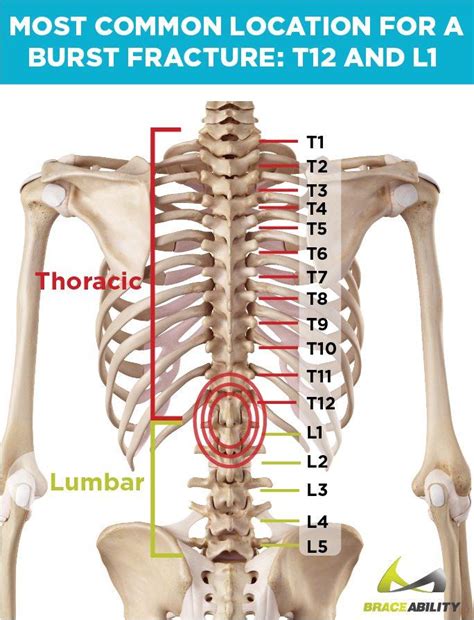 What Does It Mean If Ive Been Diagnosed With A T12 Or L1 Vertebral Burst Fracture Thoracic