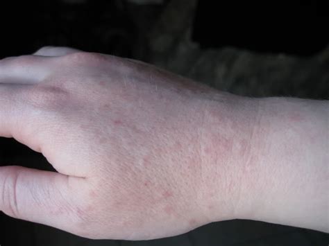 Swollen Rash On Hands