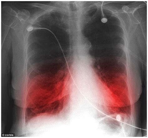 Chronic Bronchitis And Emphysema Among Smokers Could Raise The Chance
