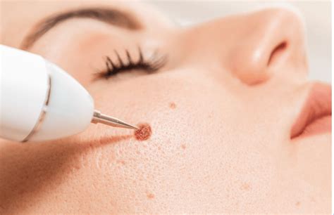 Mole Removal Archives Pinnacle Dermatology