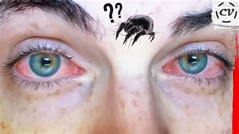 Waking Up With Red Eyes Every Day Allergic To Dust Mites Youtube